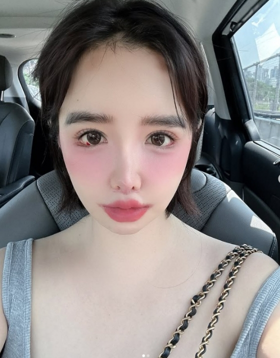 Park Bom of 2NE1 concerned fans with eye health issues visible in recent photos