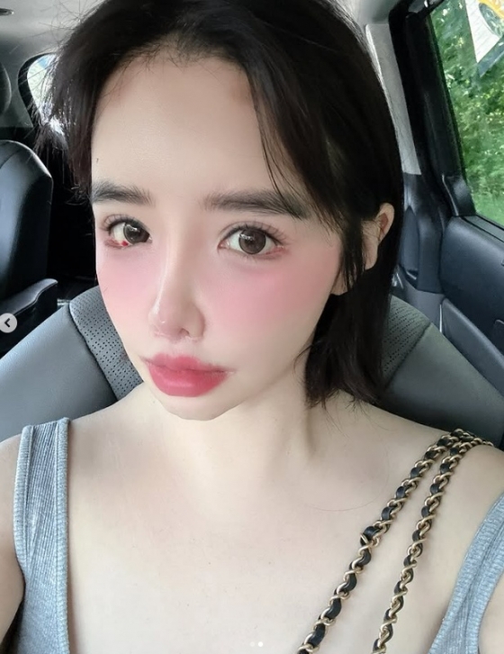 2NE1's Park Bom raised health concerns with recent SNS photos showing eye redness
